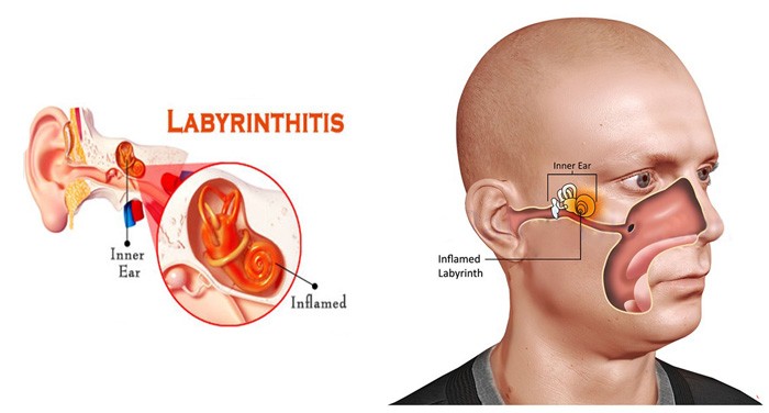 Labyrinthitis-Causes