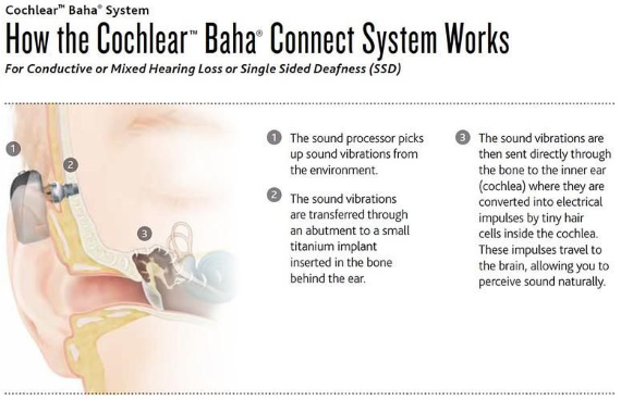 cochlear-baha