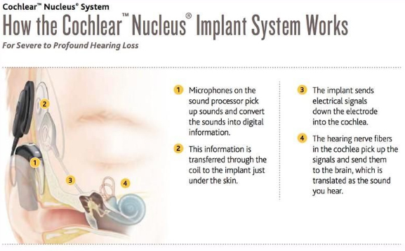 how-cochlear-implants-work
