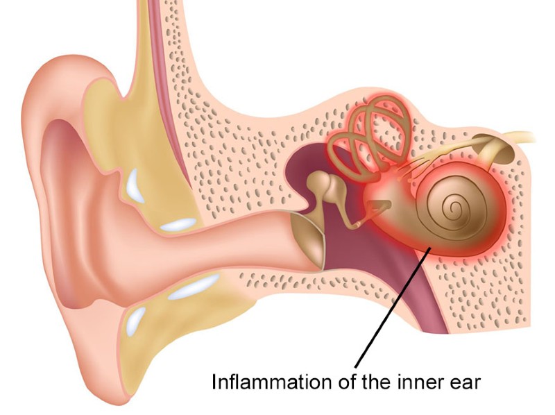 inner ear inflammation